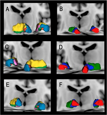 Investigadores do INESC TEC lideram descoberta que ajuda à identificação de subestruturas cerebrais com relevância neurocirúrgica