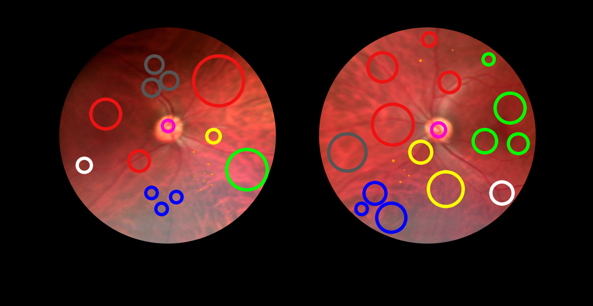 Artigo sobre retinopatia diabética vence Best Paper Award nos EUA 