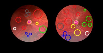 Artigo sobre retinopatia diabética vence Best Paper Award nos EUA 