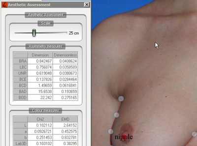 INESC Porto IT System will Assess Breast Cancer Interventions