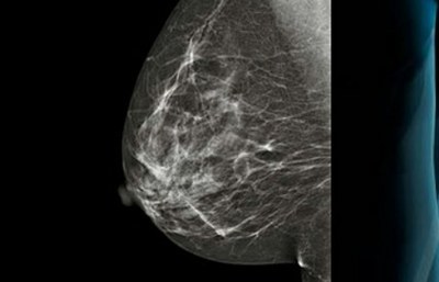 MammoClass helps diagnose Breast Cancer