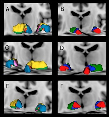 Portuguese researchers discover substructures in the brain that are relevant for surgical procedures